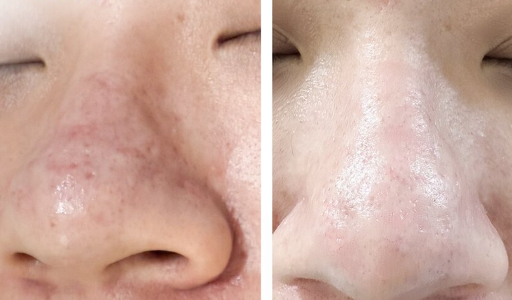 Điều trị sẹo rỗ ở mũi bằng công nghệ Laser Fractional CO2