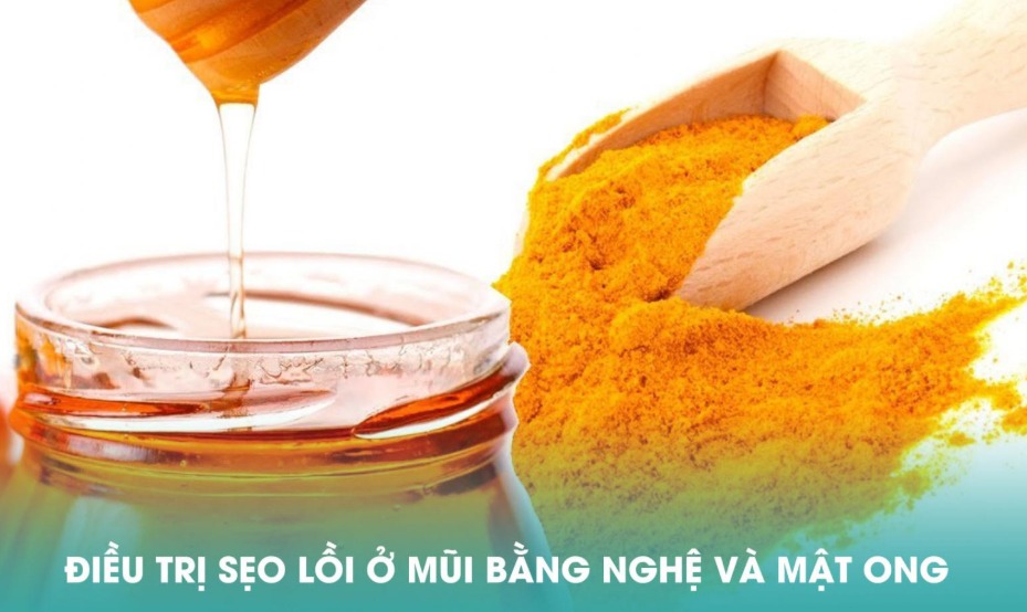 Điều trị sẹo rỗ ở mũi bằng nguyên liệu thiên nhiên