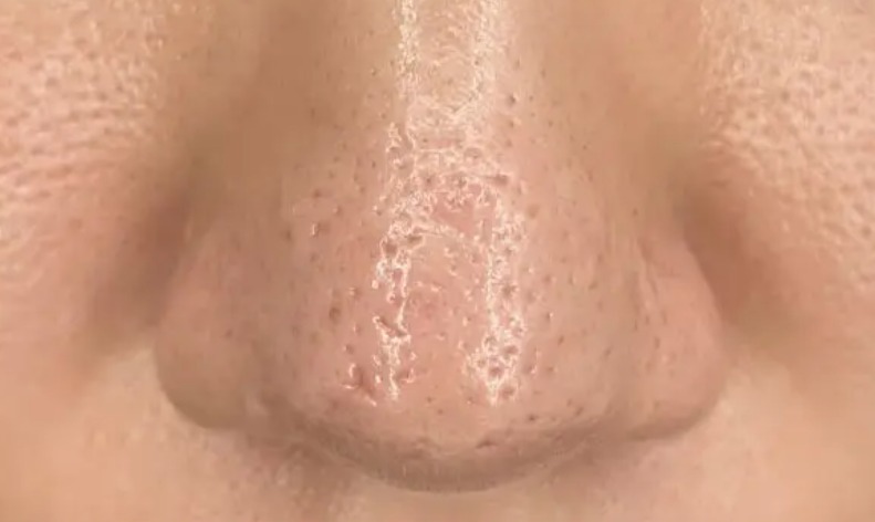 Nguyên nhân tình trạng sẹo rỗ ở mũi
