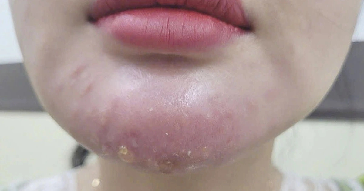 Biến chứng lệch form thật sau khi tiêm filler cằm