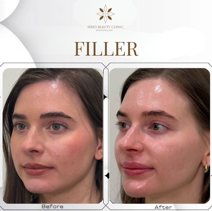 Tiêm filler tại HBIO Clinic