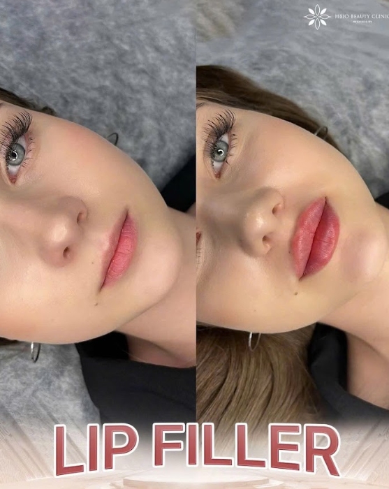 Khách hàng tiêm filler môi tại HBIO Clinic