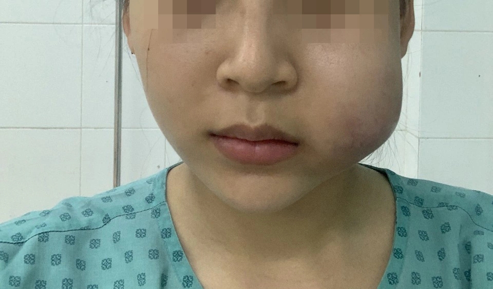 Chấn thương mô cơ học khi tiêm filler bị sưng