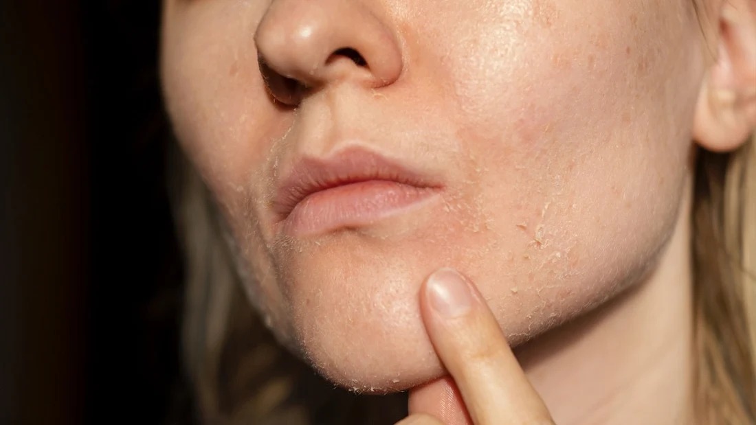 Da mặt bị khô đỏ rát do dùng nhiều hoạt chất mạnh