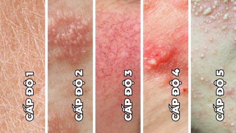 Da nhiễm corticoid tiêm meso liệu có nguy hiểm không?