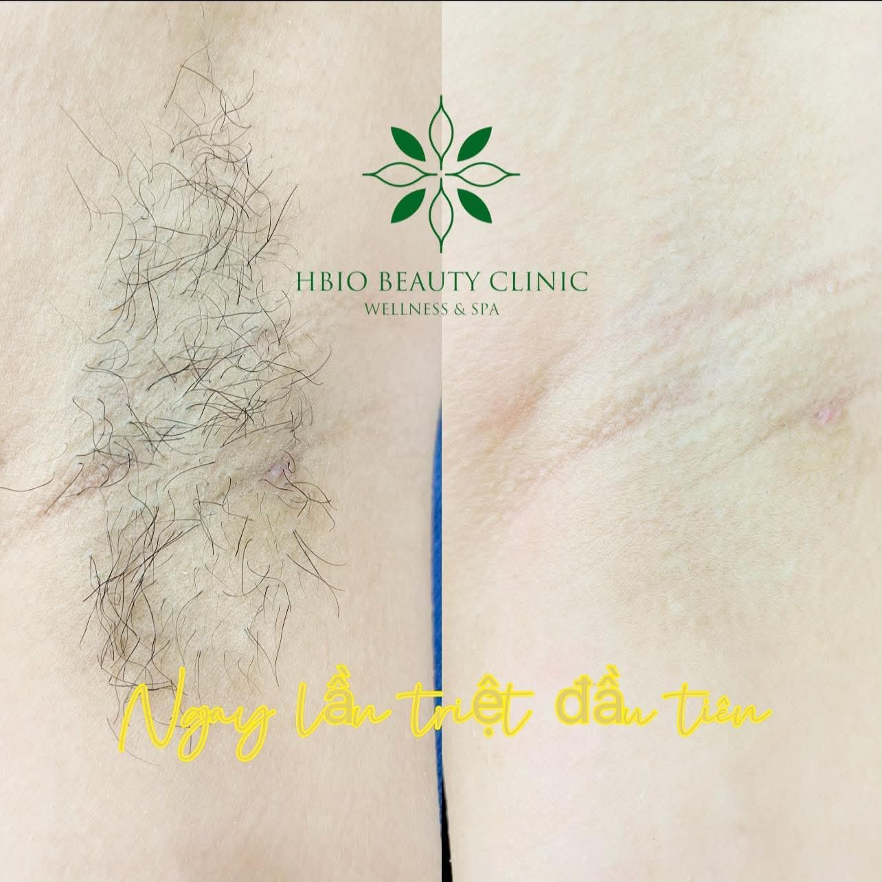 Trước và sau khi triệt lông tại HBIO Clinic
