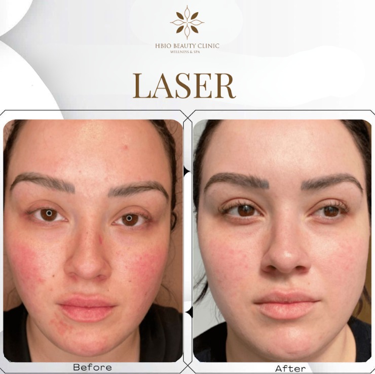 Laser acne treatment at HBIO Clinic