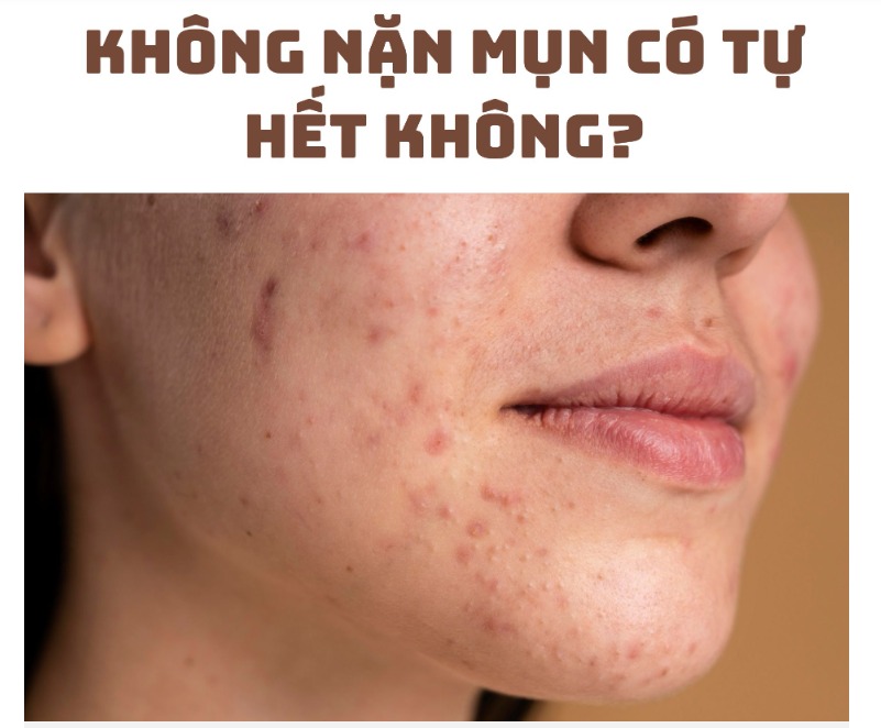 Do cystic pimples go away on their own?