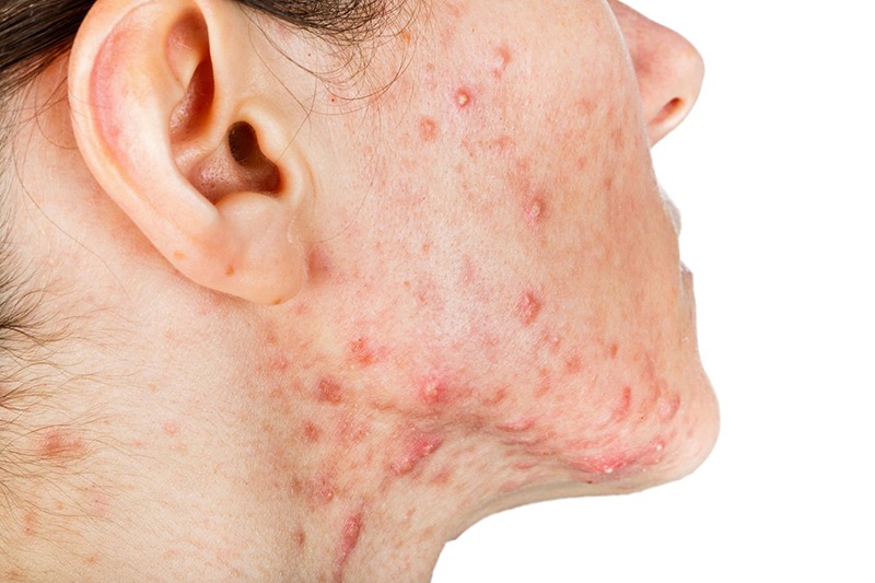 Dấu hiệu nhận biết mụn nang