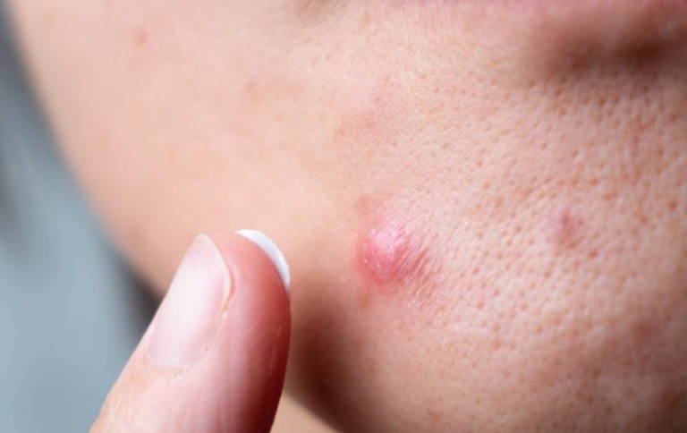 Do cystic acne lesions go away on their own? How to manage acne at home