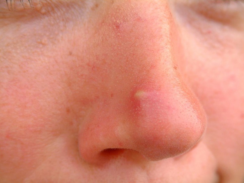 Causes of Facial Cystic Acne