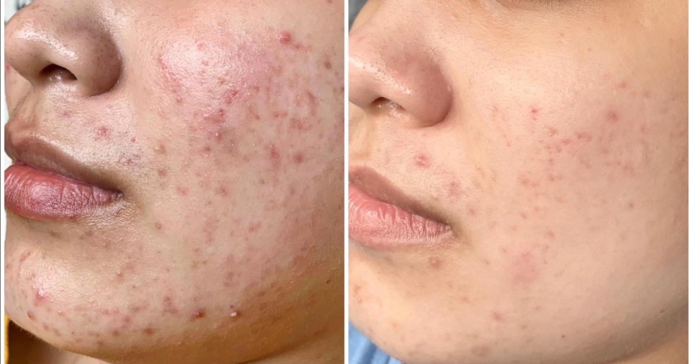 Acne Treatment at HBIO Clinic