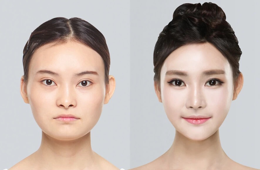 Chi phí thực hiện tạo khóe môi cười tham khảo