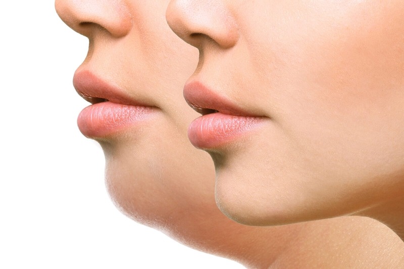 Có thể kết hợp cả tiêm filler và phẫu thuật độn cằm không?