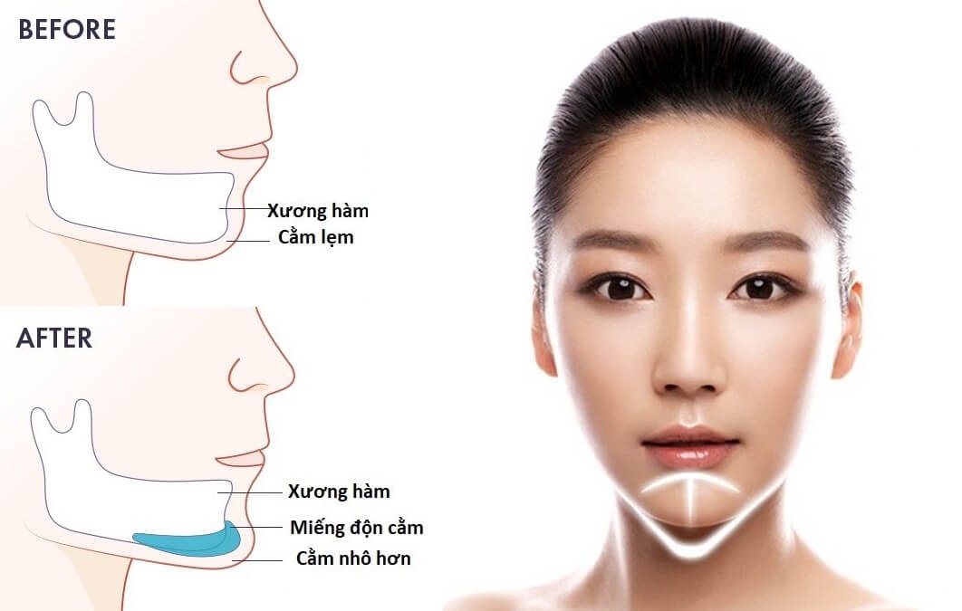 Các trường hợp nên chọn độn cằm