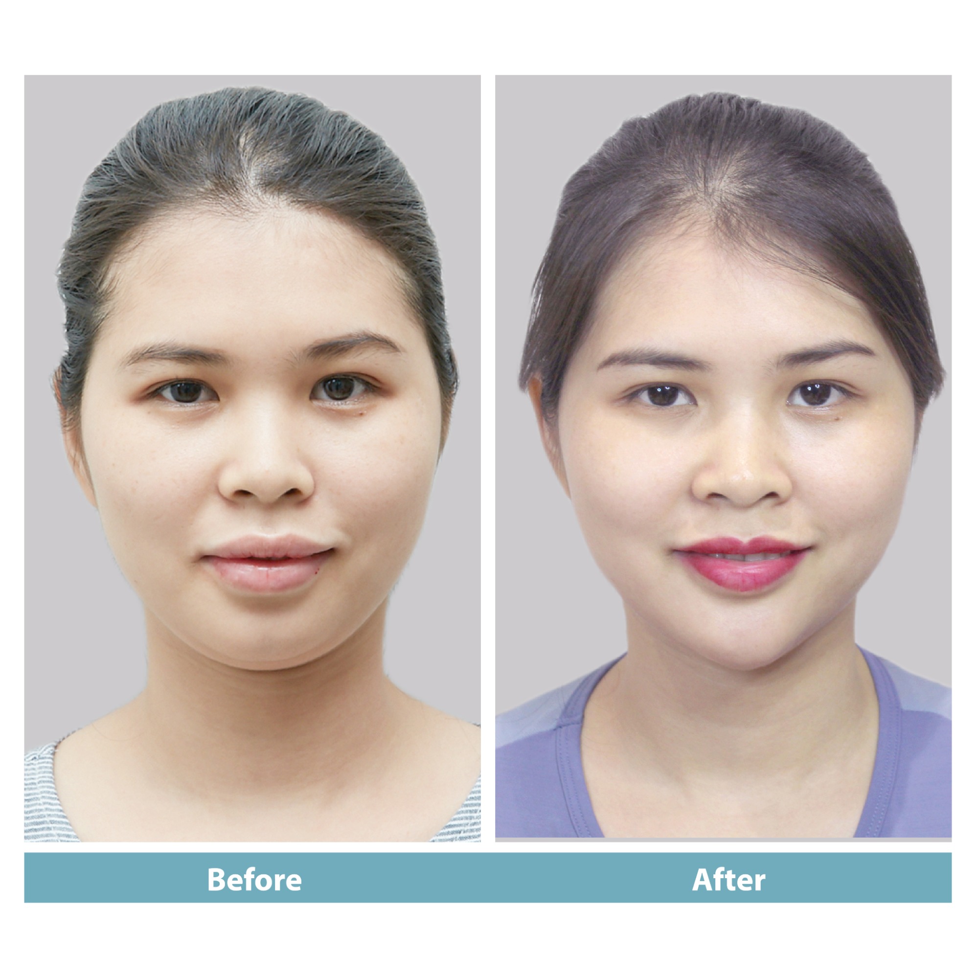 Các trường hợp nên chọn tiêm filler