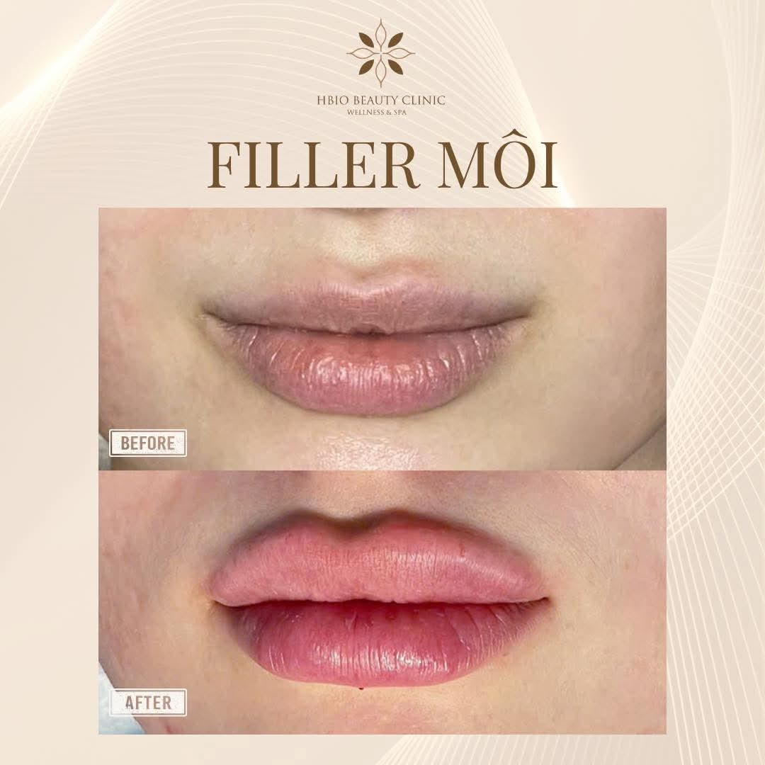 Hình ảnh trước và sau khi tiêm filler môi tại HBIO Clinic