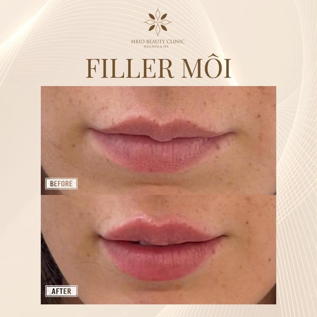 Hình ảnh trước và sau khi tiêm filler môi tại HBIO Clinic