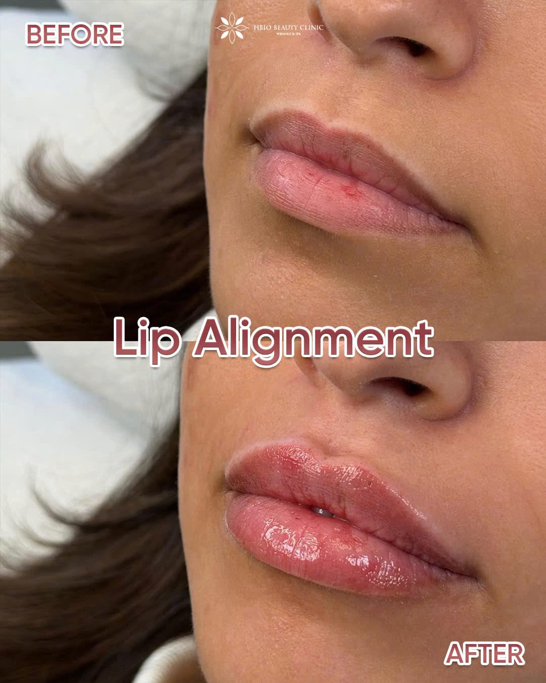Before-and-after images of lip filler injections at HBIO Clinic.