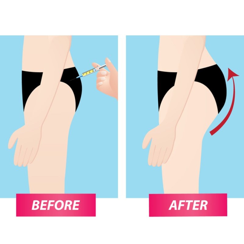 Filler mông có thể duy trì vĩnh viễn không?
