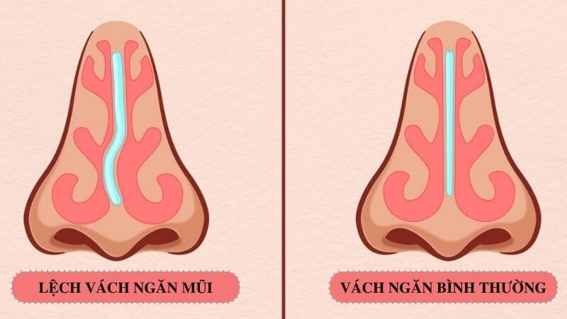 Nguy cơ dịch chuyển và lệch form dáng mũi