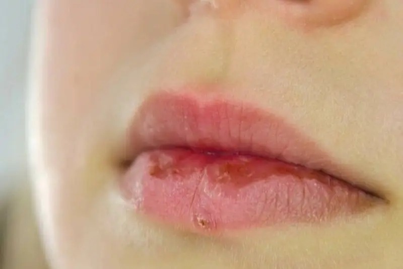 Tiêm filler môi bị bầm có nguy hiểm không?