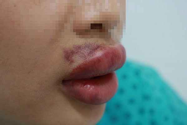 Bí quyết phòng tránh tình trạng bầm tím sau khi tiêm môi