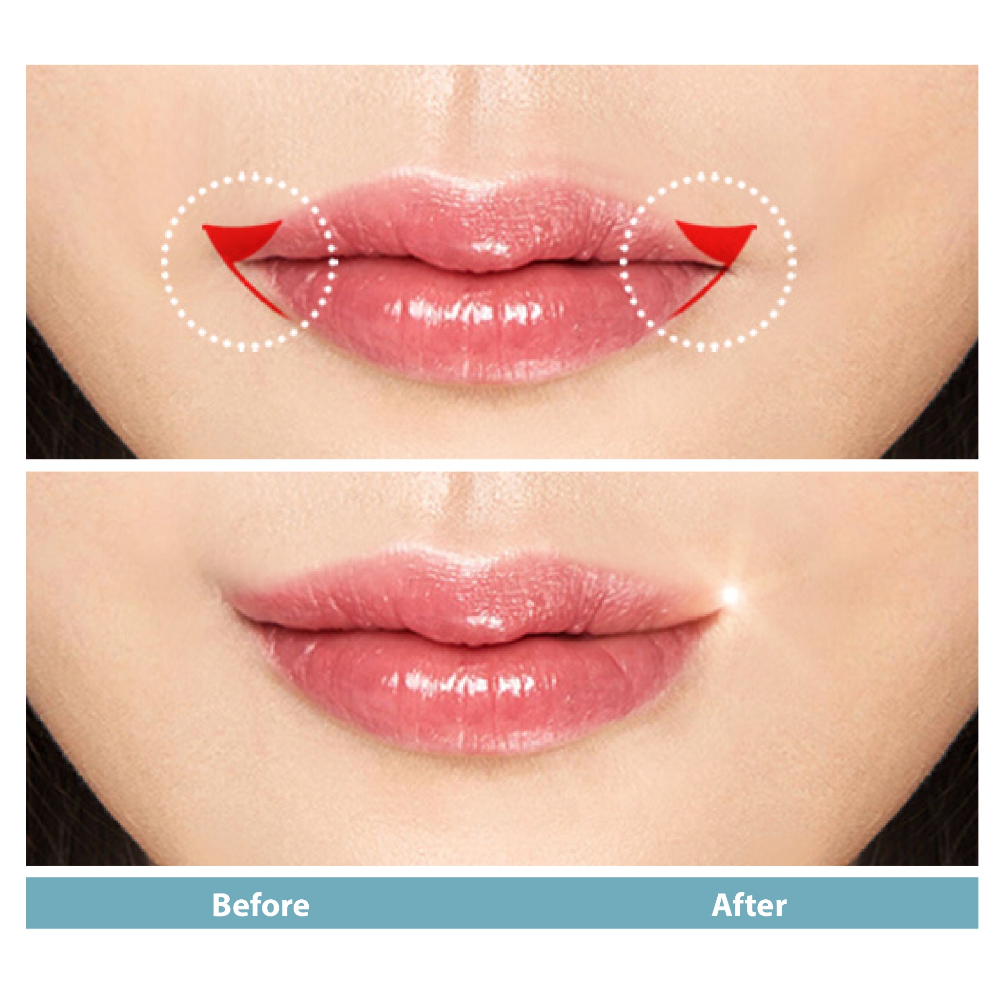 Trước khi tiêm môi cười