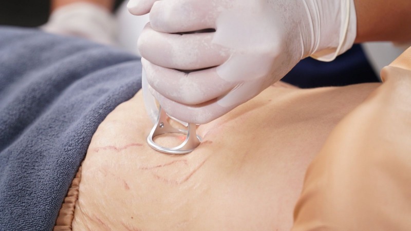 Các vị trí thường xuất hiện rạn da