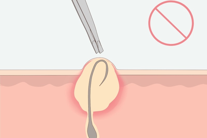 Không nên tự ý cạo hoặc nhổ tại vùng viêm