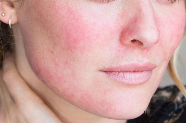 Bí quyết phòng ngừa tình trạng triệt lông mặt bị nổi mụn