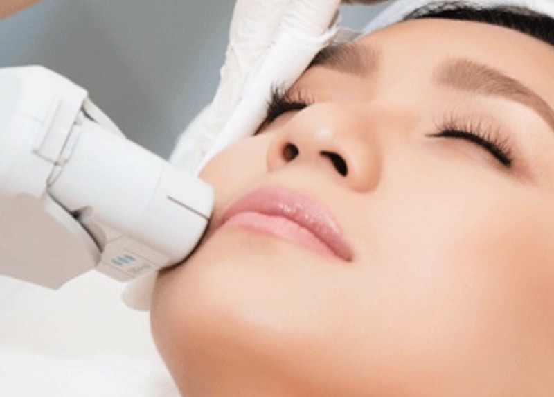 Triệt ria mép vĩnh viễn là gì?