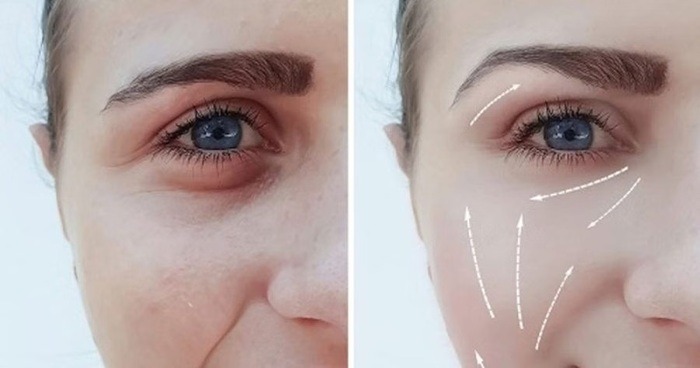 Trũng má malar mound ảnh hưởng thế nào đến sức khỏe?