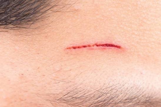 Da có vết thương hở tuyệt đối không nên peel
