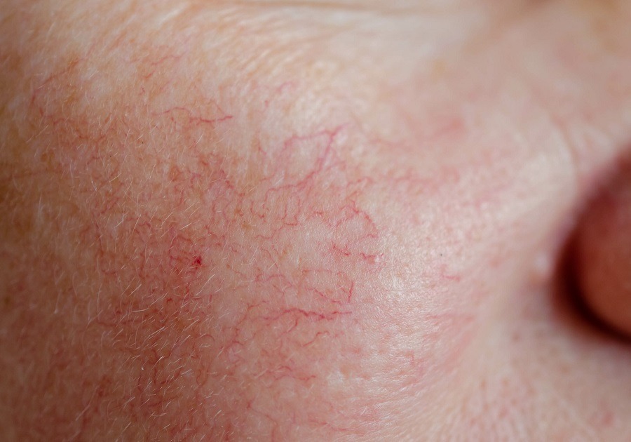 Sử dụng sản phẩm phục hồi chuyên sâu cho da giãn mao mạch