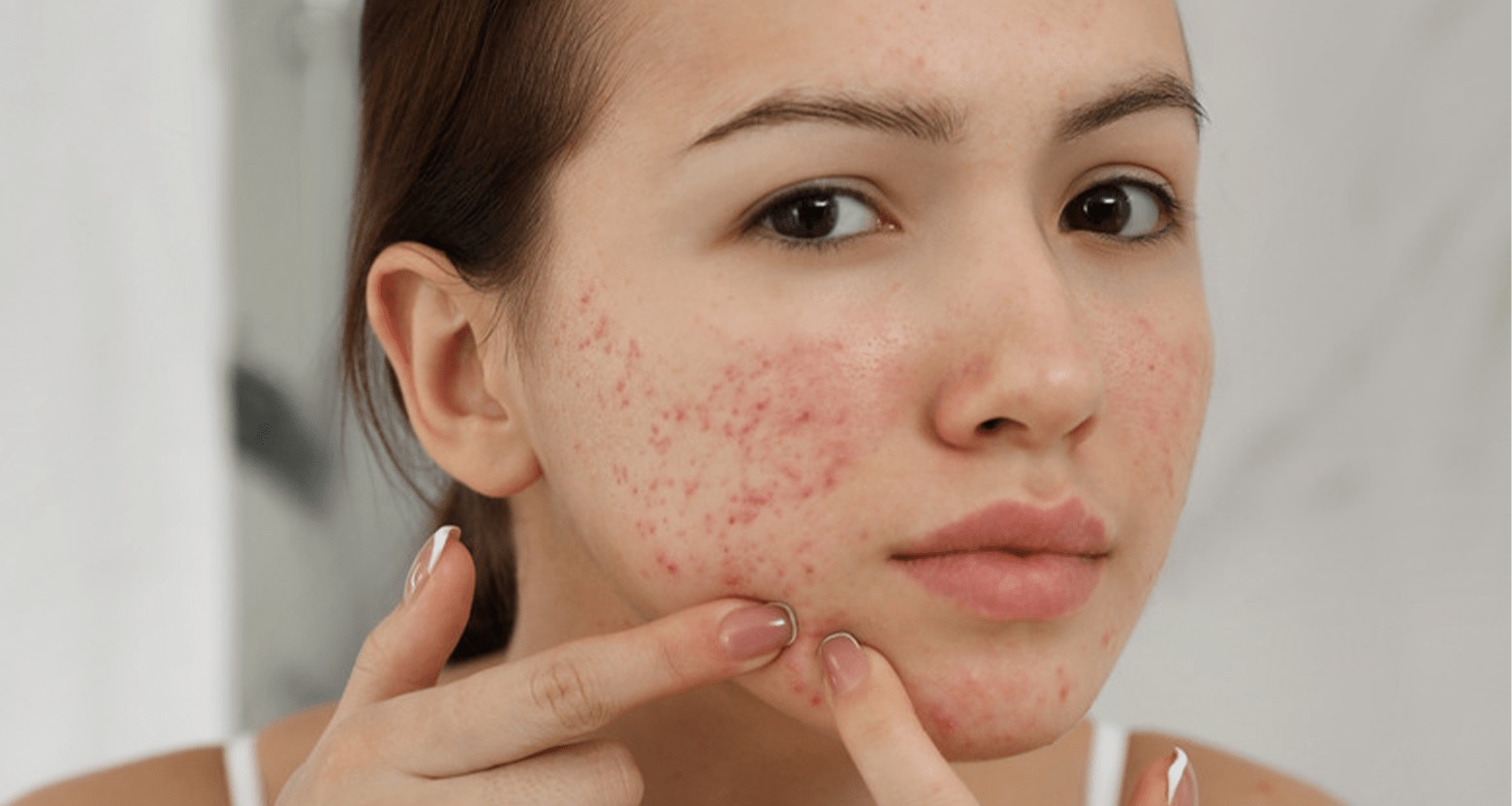Mụn bọc ở má có nên tự nặn không?