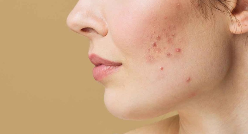 Dấu hiệu nhận biết bị mụn bọc ở má