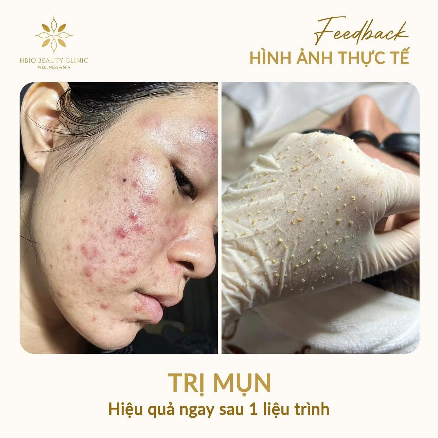 Điều trị mụn tại HBIO Clinic