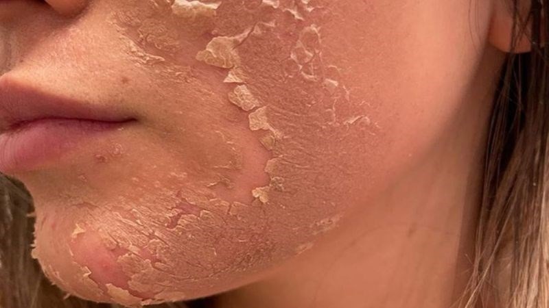 Chăm sóc da sau khi peel glycolic acid