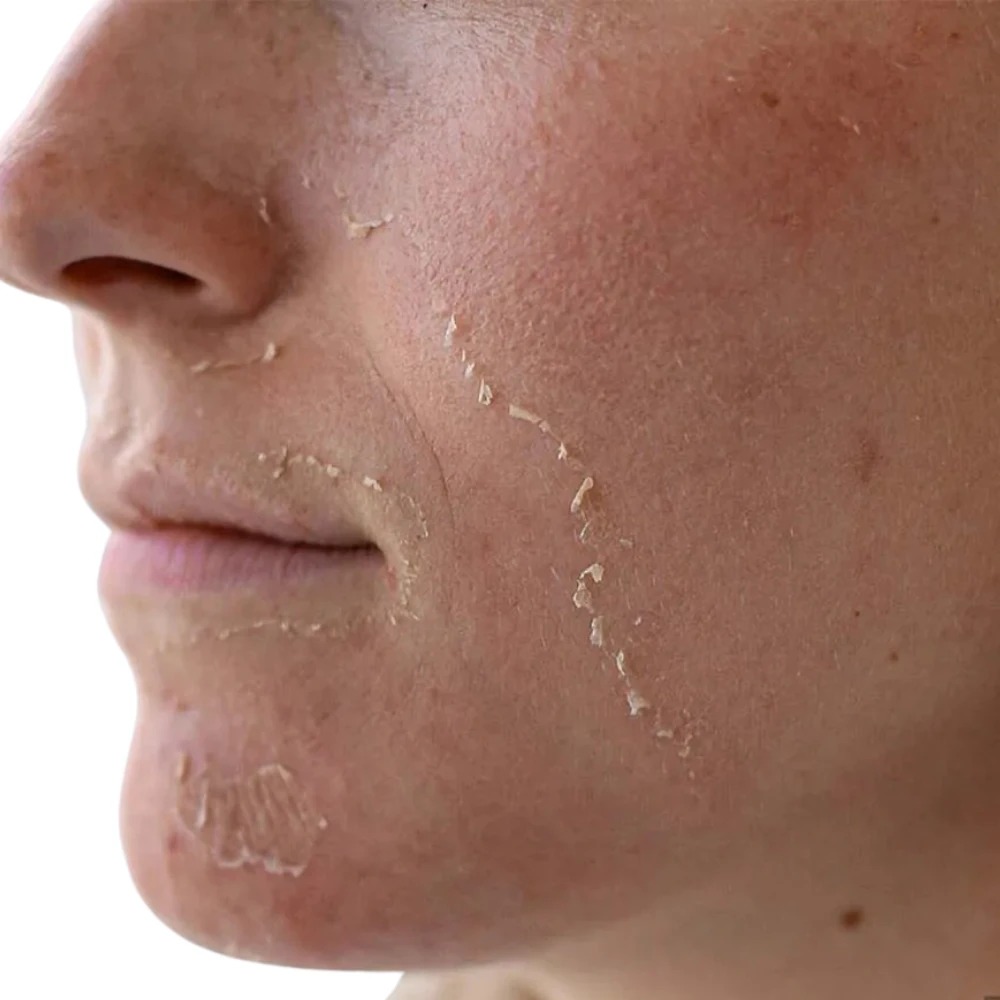 Lợi ích vượt trội khi thực hiện peel Glycolic Acid