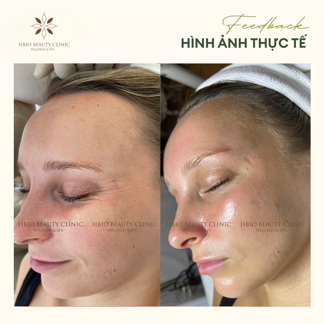 Da khách hàng peel tại HBIO Clinic