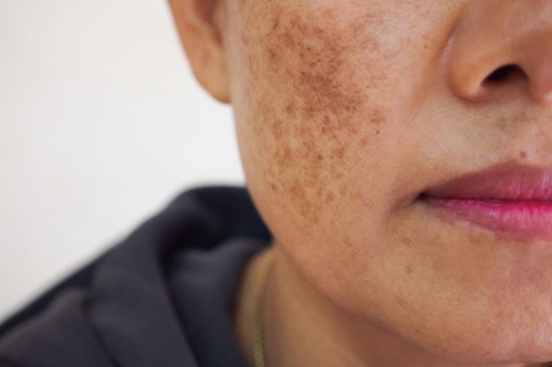 Nguyên nhân phổ biến khiến bạn bị rối loạn sắc tố da