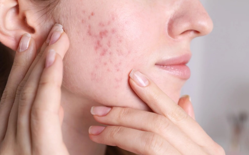 Có nên đi spa trị thâm mụn không?