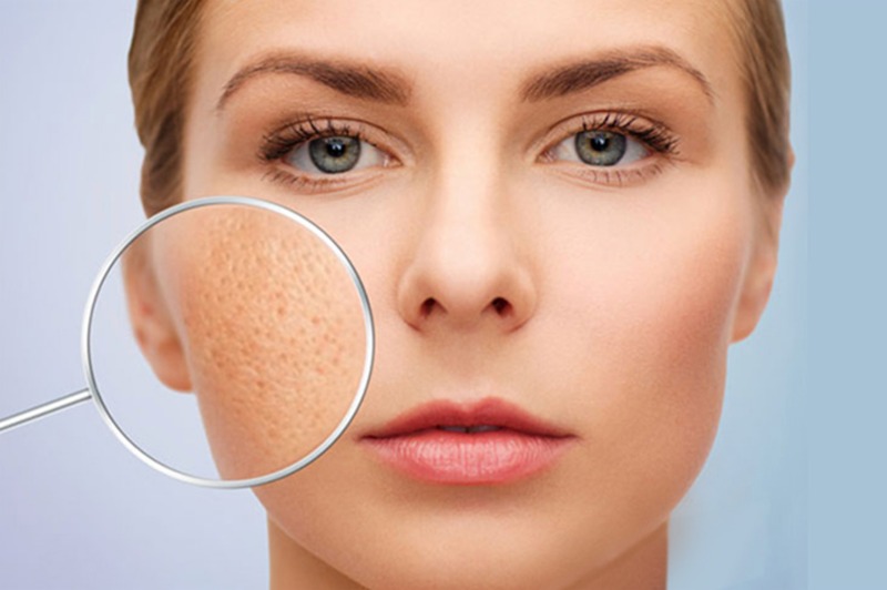 Sẹo rỗ có mấy loại?