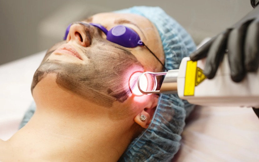 Laser Long Pulse trị mụn viêm là gì?