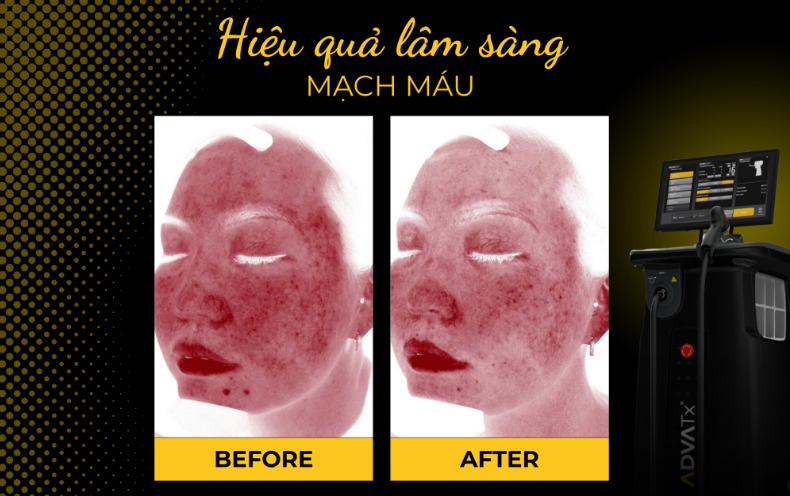 Công nghệ PDL (Pulsed Dye Laser)