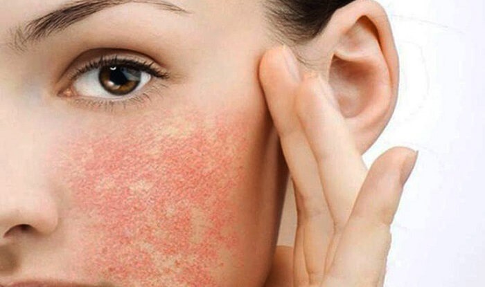 Dấu hiệu nhận biết da bị cháy nắng