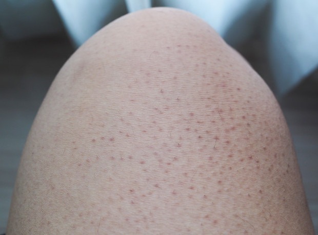 Trường hợp da nổi sần kèm cảm giác ngứa ngáy