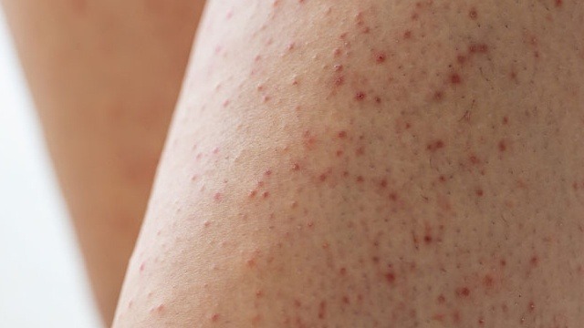 Da bị nổi sần như da gà là hiện tượng gì?