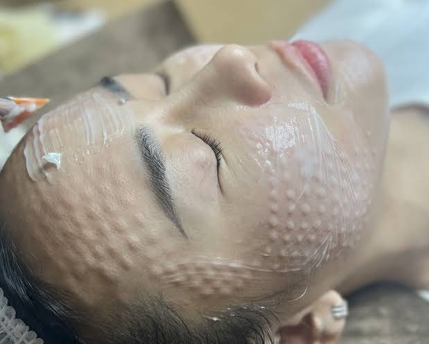 Tiêm dưỡng chất (Mesotherapy / Filler)